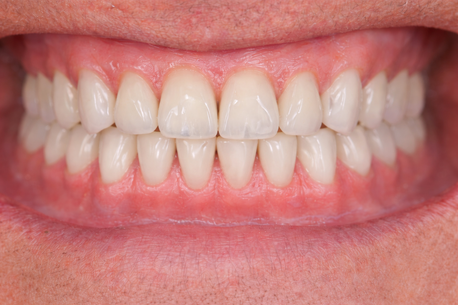 After Dental Treatment in Baltimore