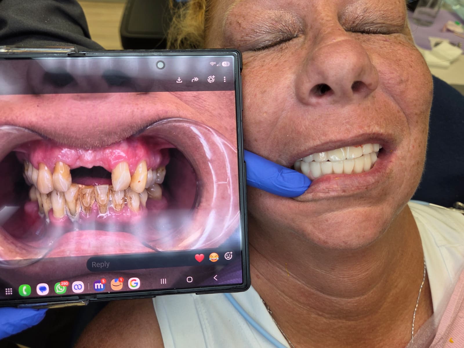 Dental implant result 2