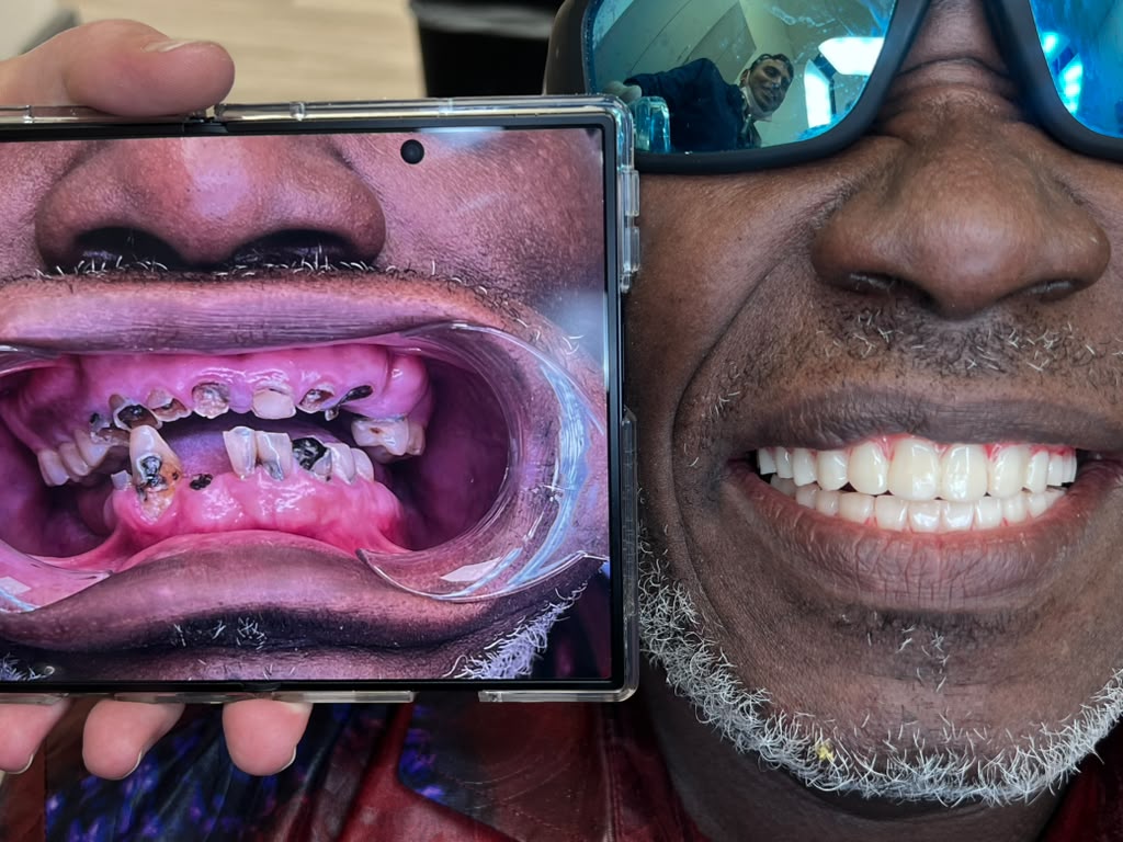 Dental implant result 3