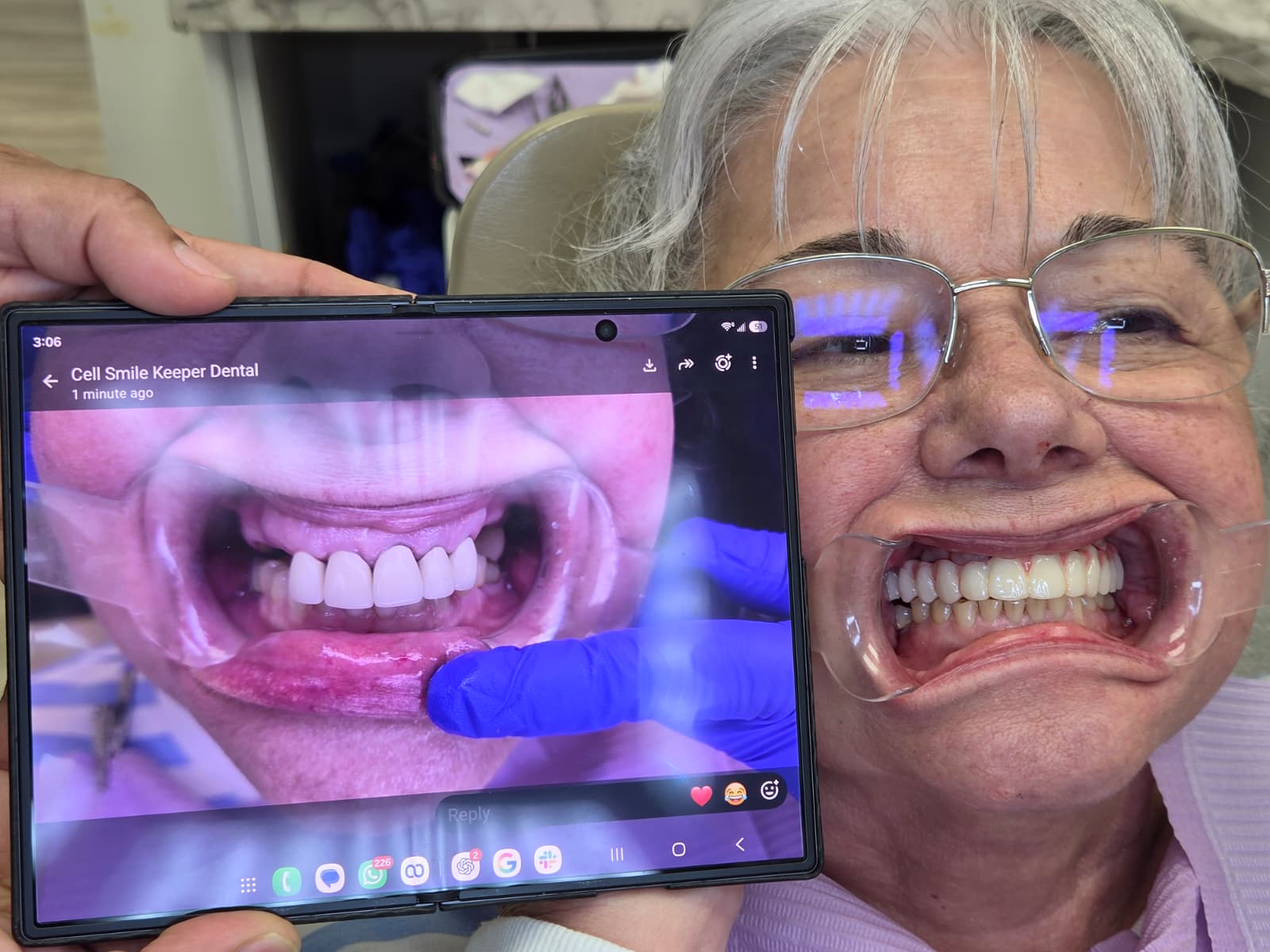 Dental implant result 4