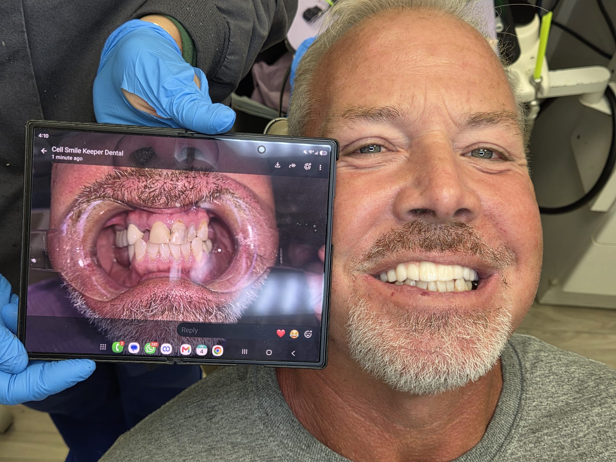 Dental implant result 2
