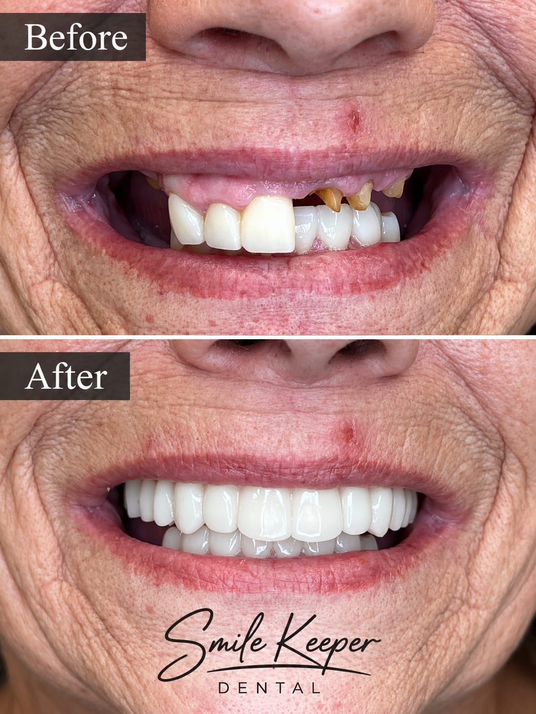 Dental implant result 4