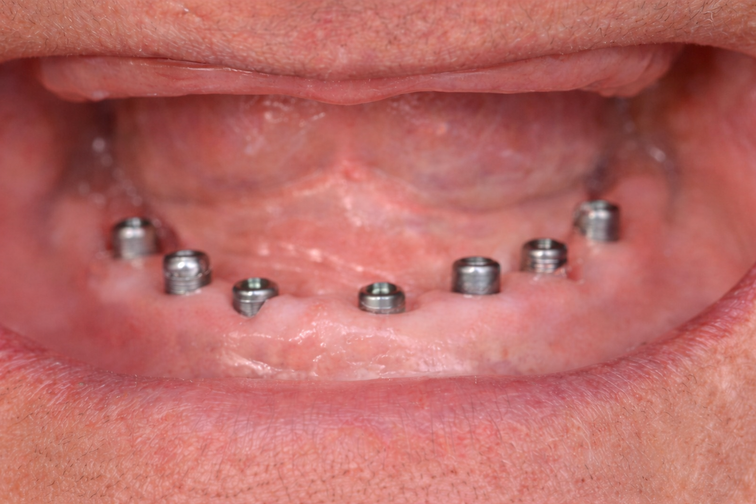 Before Dental Treatment in Baltimore