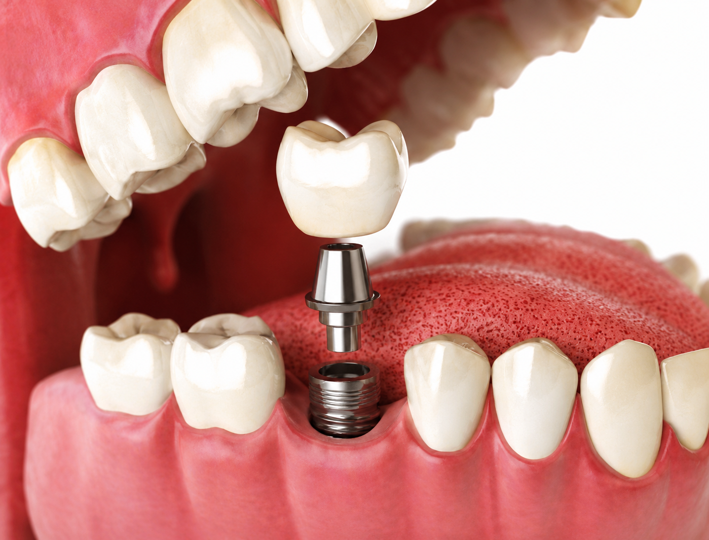 Single Tooth Implant Glen Burnie