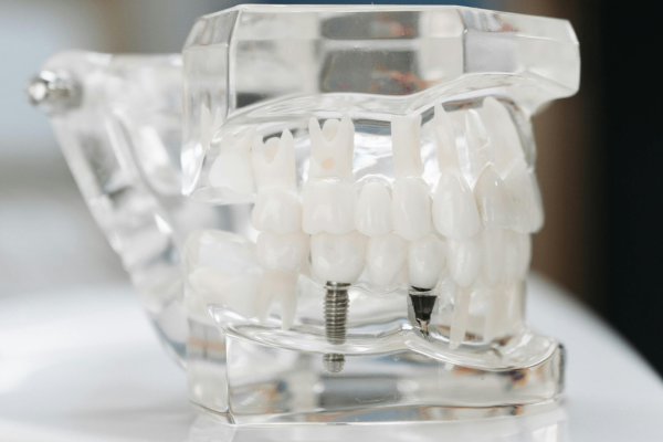 Dental Implants